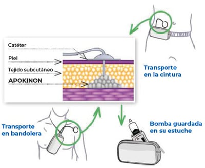 Celnova - Apokinon: Solución para perfusión